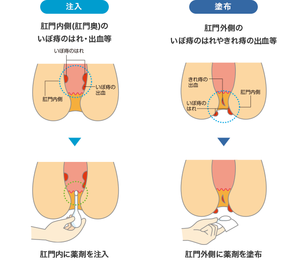 プリザエース注入軟膏Tは、肛門内側(肛門奥)の痔には注入、肛門外側の痔には塗布と、部分・症状によって使用方法を選ぶことが出来ます。