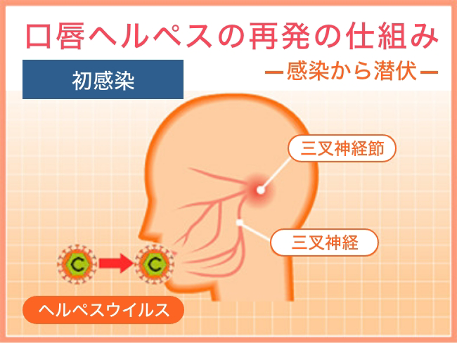 口唇ヘルペス再発の仕組み 感染から潜伏