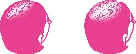 女性の壮年性脱毛症の脱毛パターンのイラスト