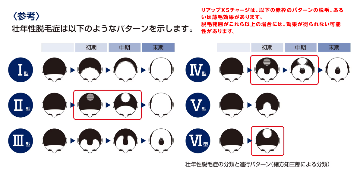 壮年性脱毛症の脱毛パターンのイメージ図