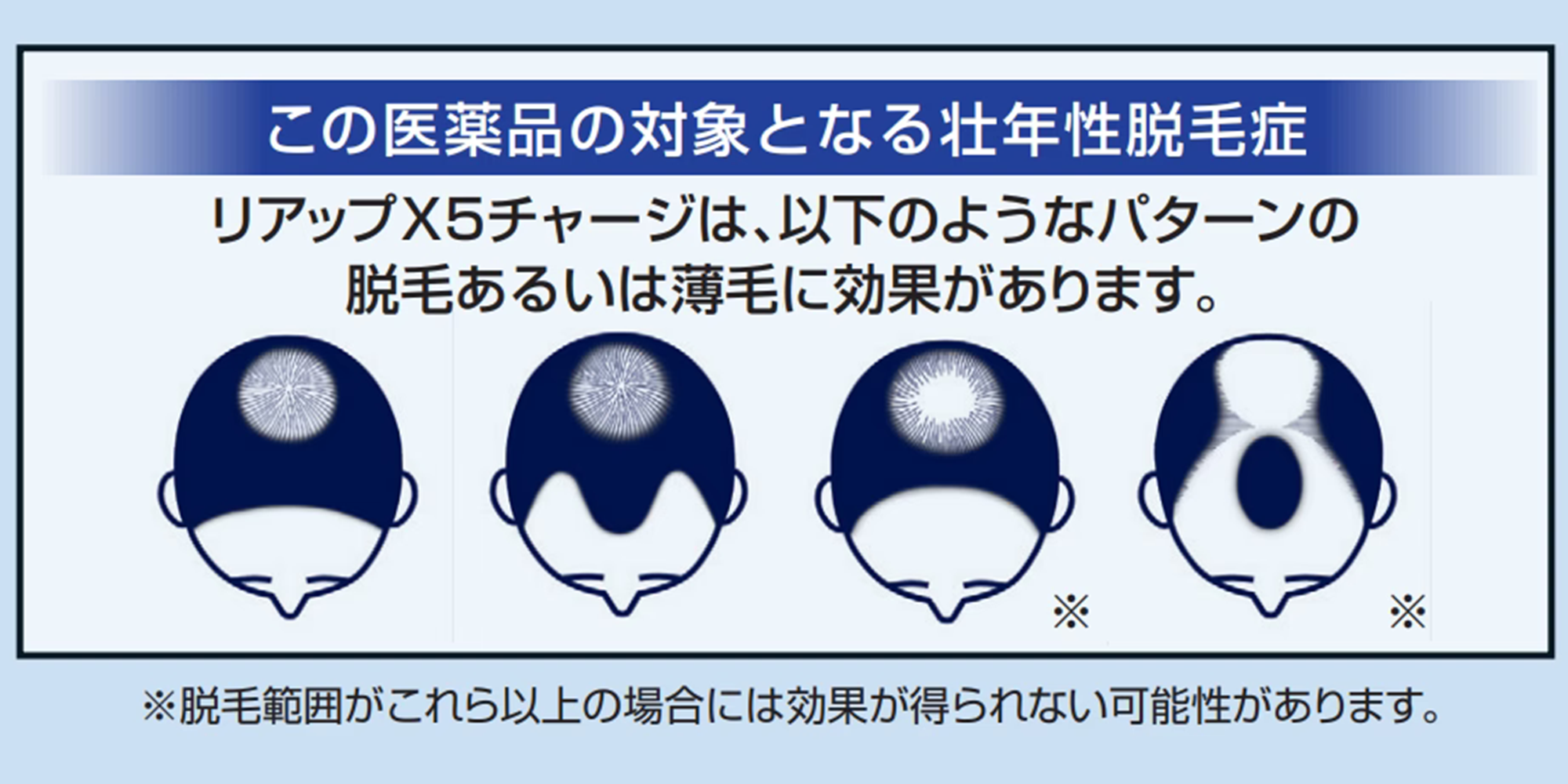 リアップX5チャージの対象となる壮年性脱毛症のイメージイラスト