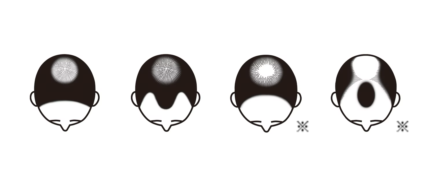 壮年性脱毛症の進行パターンの図