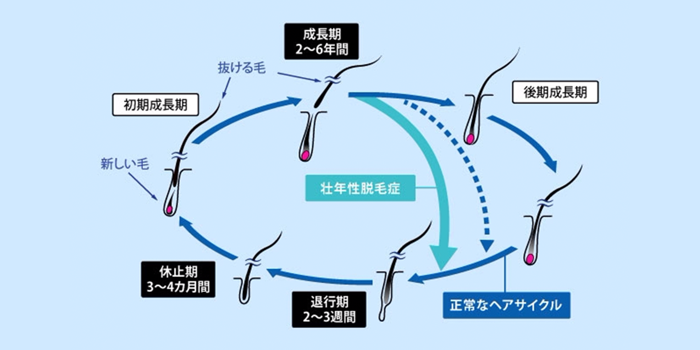 壮年性脱毛症のヘアサイクルのイメージ図