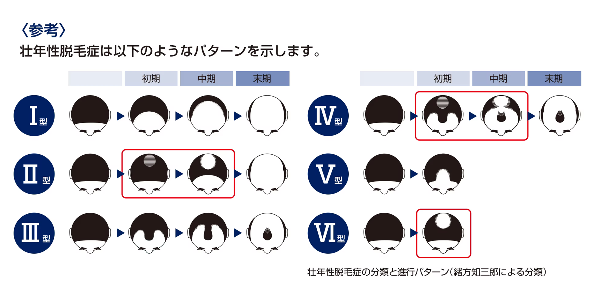 壮年性脱毛症のパターンのイメージイラスト