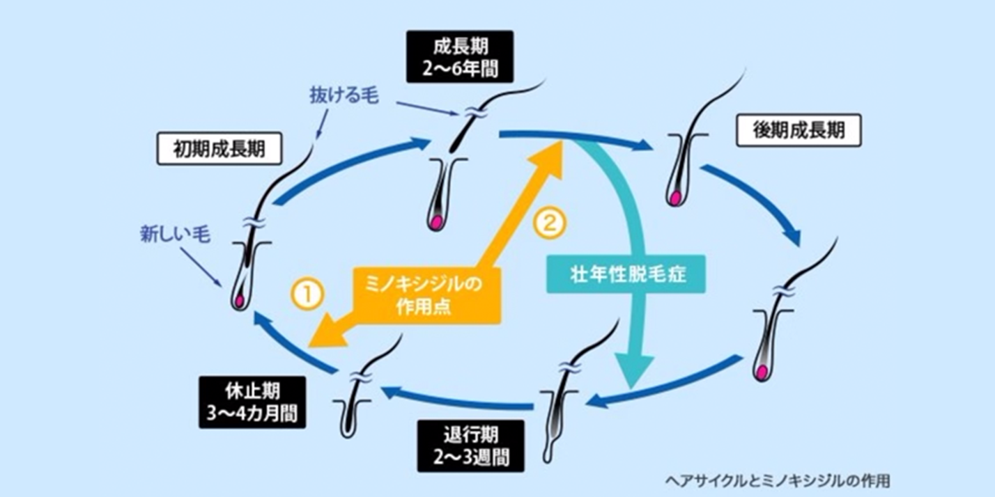 壮年性脱毛症のヘアサイクルとミノキシジルの作用のイメージ図