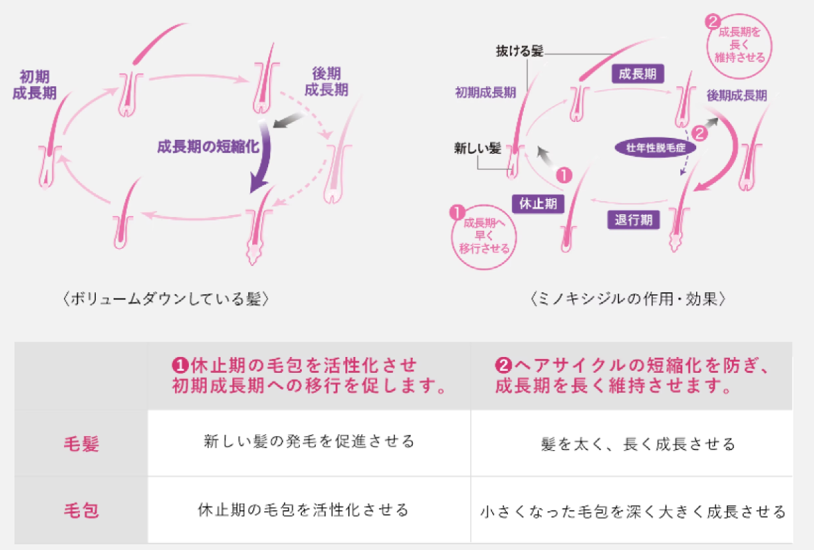 壮年性脱毛症のヘアサイクルとリアップリジェンヌの作用