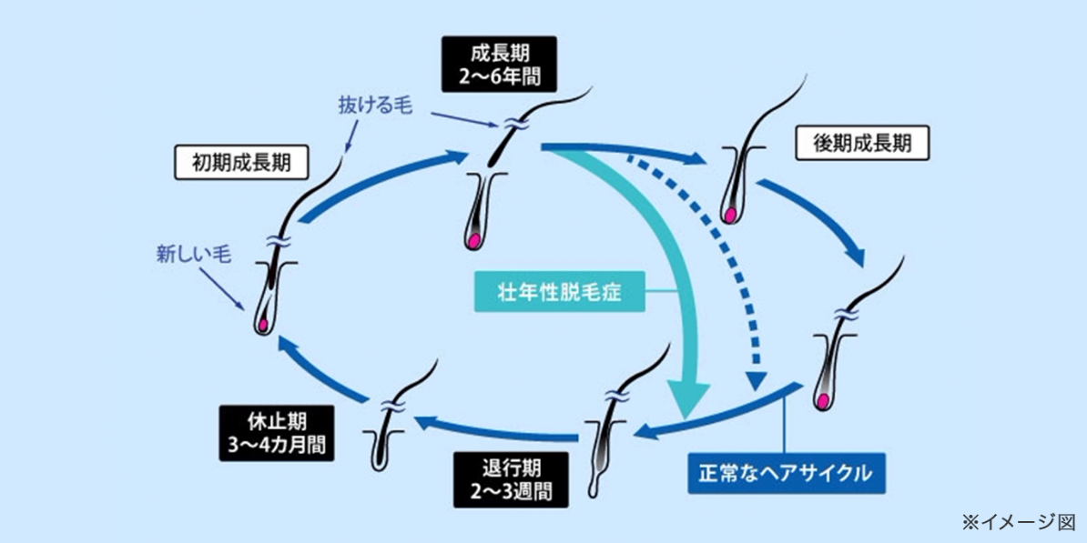 壮年性脱毛症のヘアサイクルのイメージ図