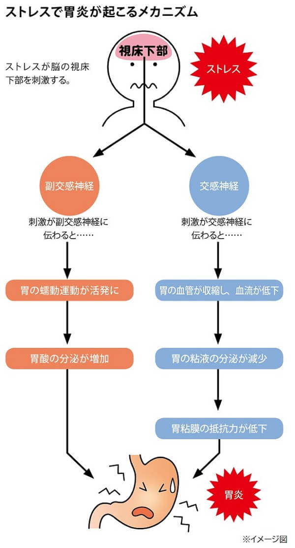 ストレスで胃炎が起こるメカニズム