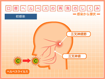 口唇ヘルペス再発の仕組み 初感染