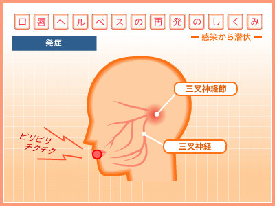 口唇ヘルペス再発の仕組み 発症