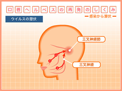 口唇ヘルペス再発の仕組み ウイルスの潜伏