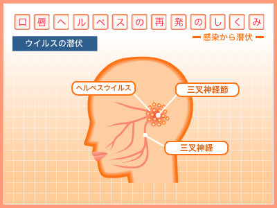 口唇ヘルペス再発の仕組み ウイルスの潜伏