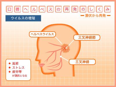 口唇ヘルペス再発のしくみ ウイルスの増殖