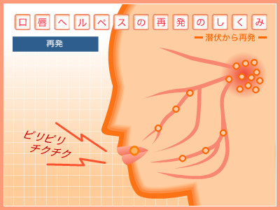 口唇ヘルペス再発のしくみ 再発