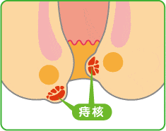 「外痔核」(がいじかく)