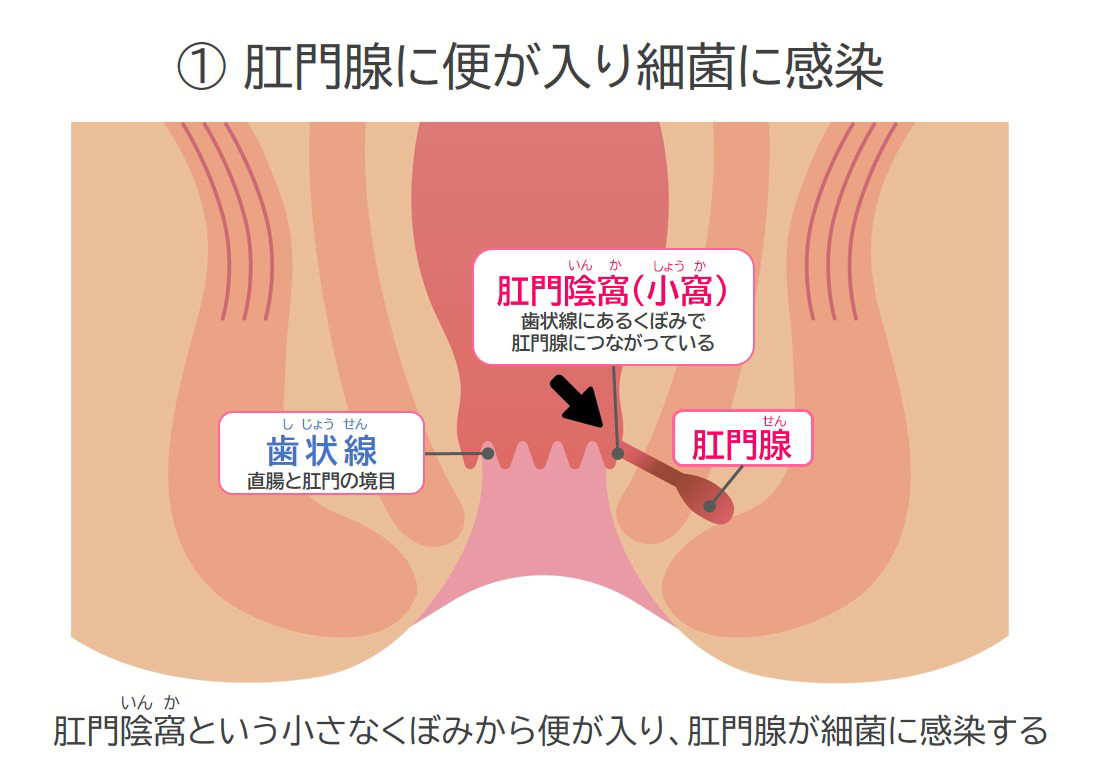 肛門腺に便が入り細菌に感染
