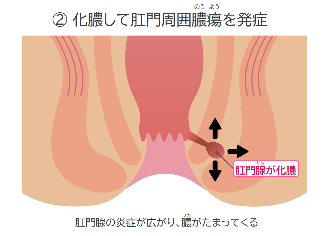 化膿して「肛門周囲膿瘍（のうよう）」を発症