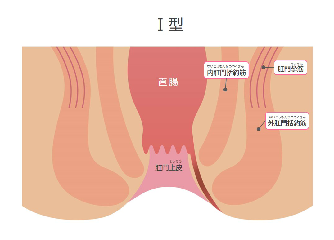 Ⅰ型痔瘻（痔ろう）