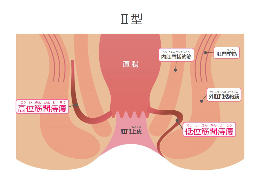 Ⅱ型痔瘻（痔ろう）