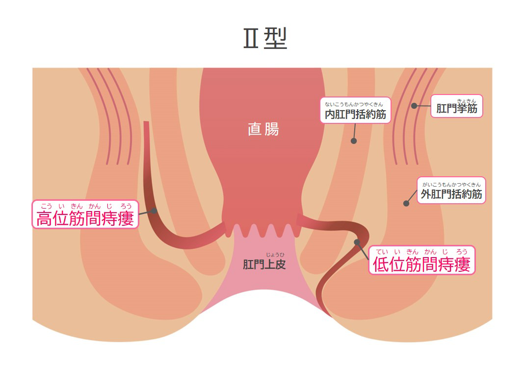 痔瘻（じろう）の原因・症状は？｜大正製薬の痔疾薬、止まって留まる ...