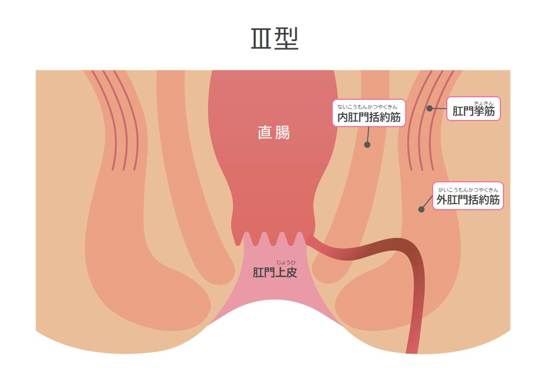 Ⅲ型痔瘻（痔ろう）