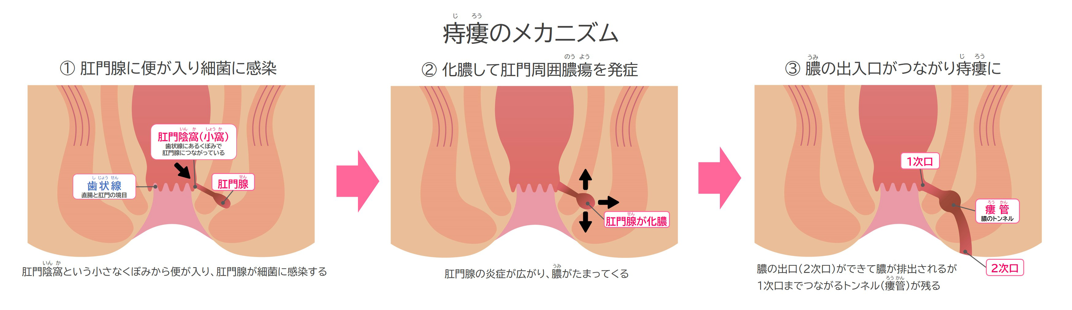 痔瘻（痔ろう）のメカニズム