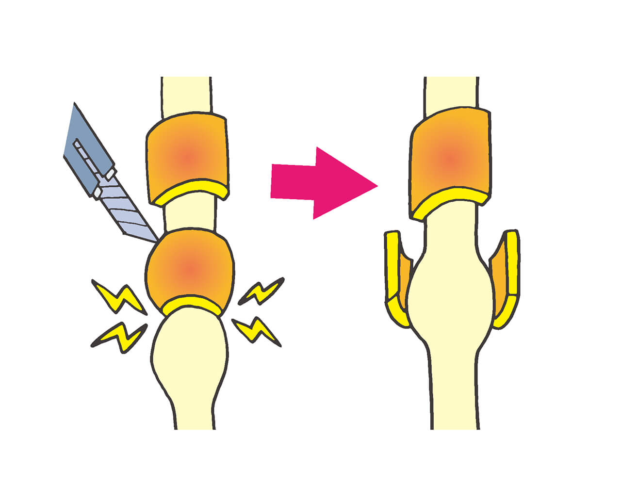 腫れて厚くなった腱鞘の一部を切開し、腱の通りをスムーズにする手術「腱鞘切開」