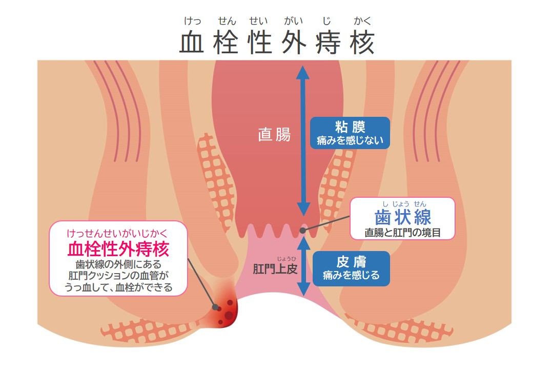 血栓性外痔核のイメージイラスト
