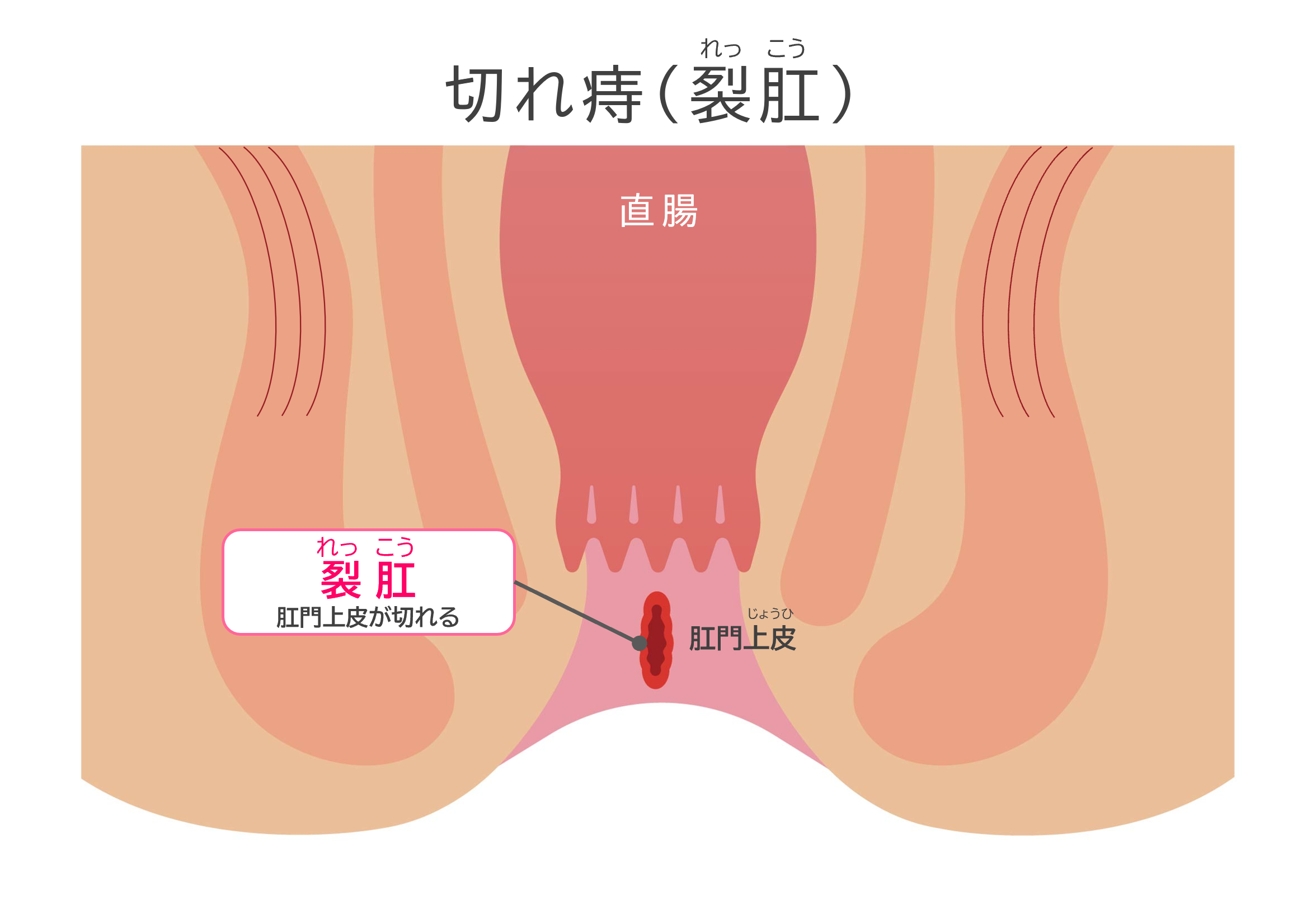 切れ痔（裂肛）のイメージイラスト