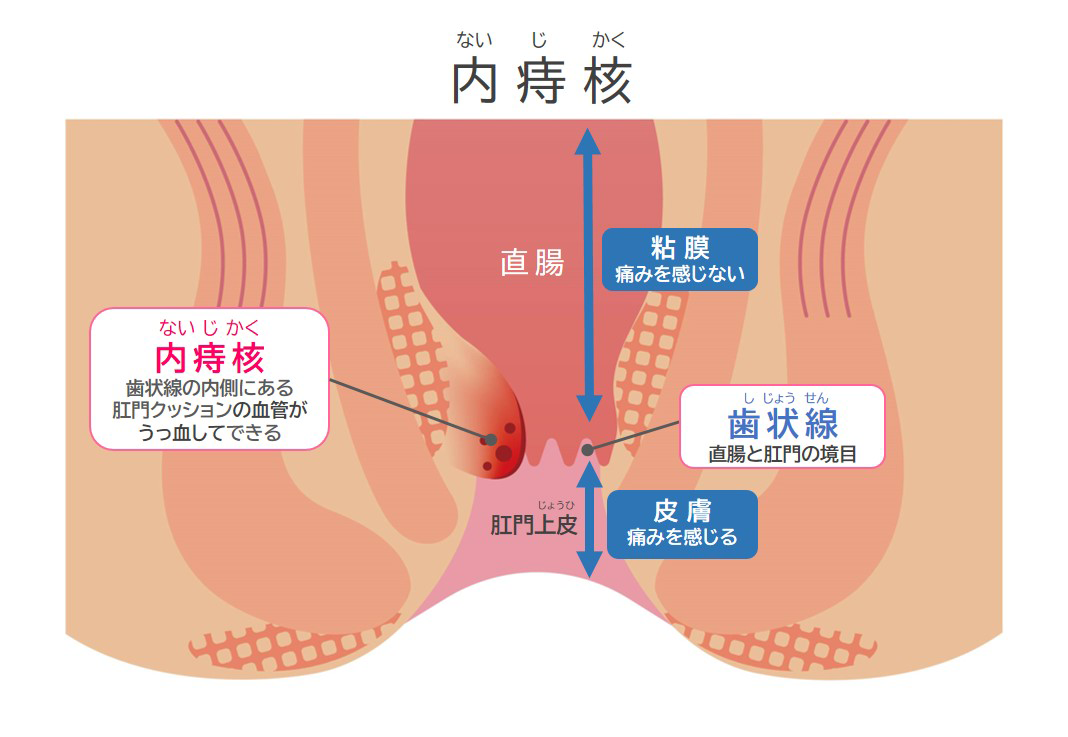 内痔核（いぼ痔）のイメージイラスト