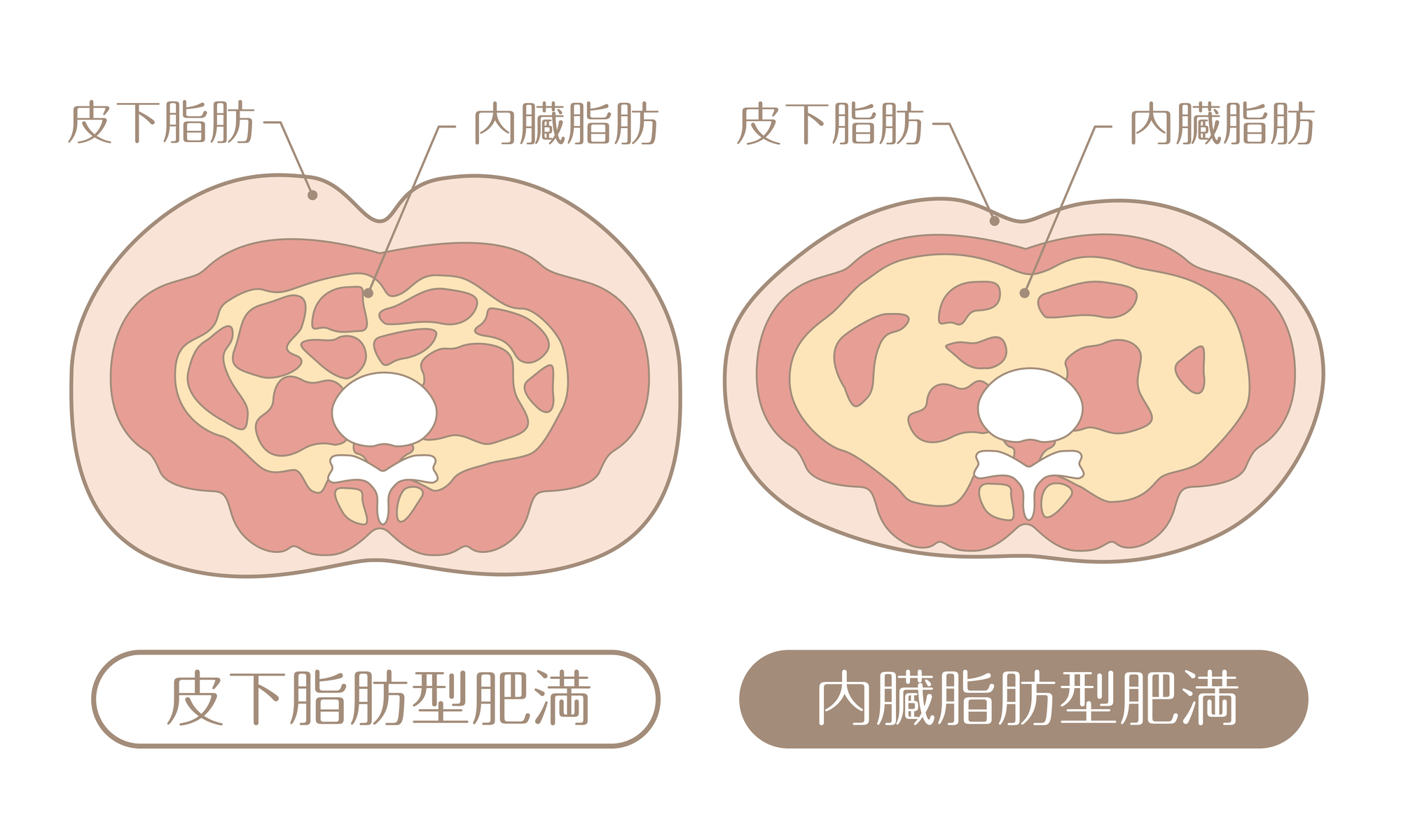 皮下脂肪型肥満と内臓脂肪型肥満の脂肪のつき方の違い
