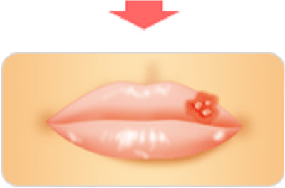 口唇ヘルペス発症1～3日後