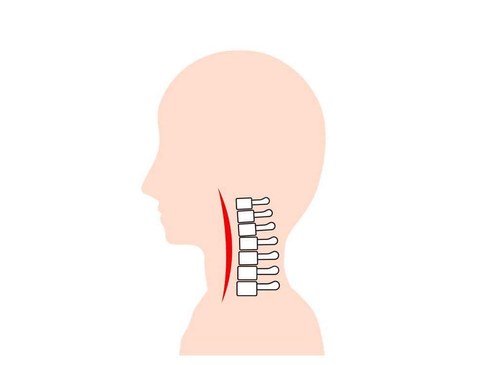 悪化して後弯している頚椎