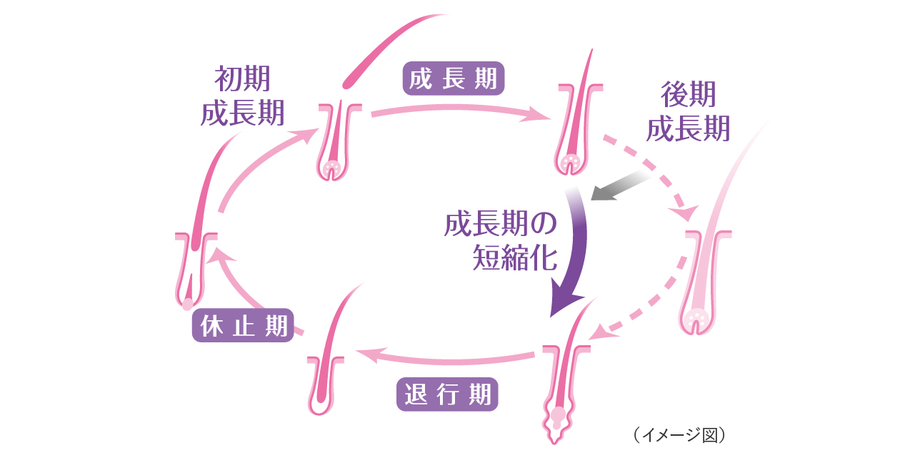 壮年性脱毛症、ボリュームダウンしている髪のヘアサイクルのイメージ図。壮年性脱毛症では成長期が短縮化する